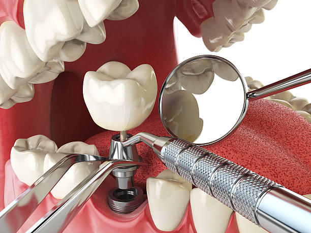 Best Emergency Denture Repair in Monument Beach, MA